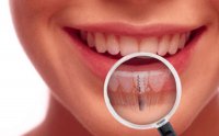Всё, что нужно знать об имплантации зубов