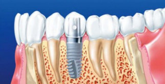 Полезная информация о протезировании зубов